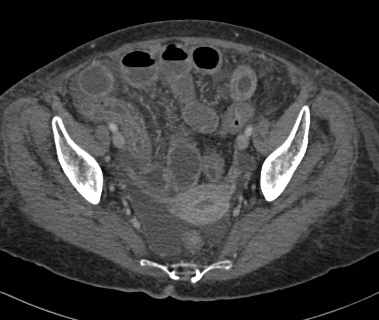 Inflammatory Bowel Disease - CTisus CT Scan