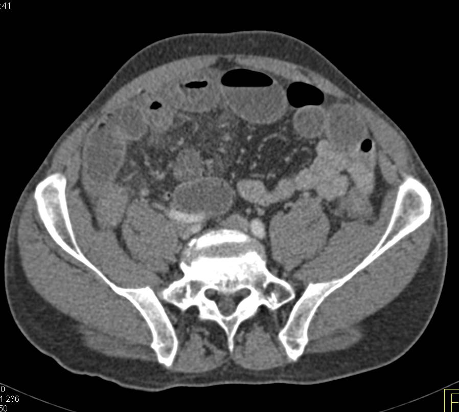 Crohn's Disease with Small Bowel Obstruction (SBO) - CTisus CT Scan