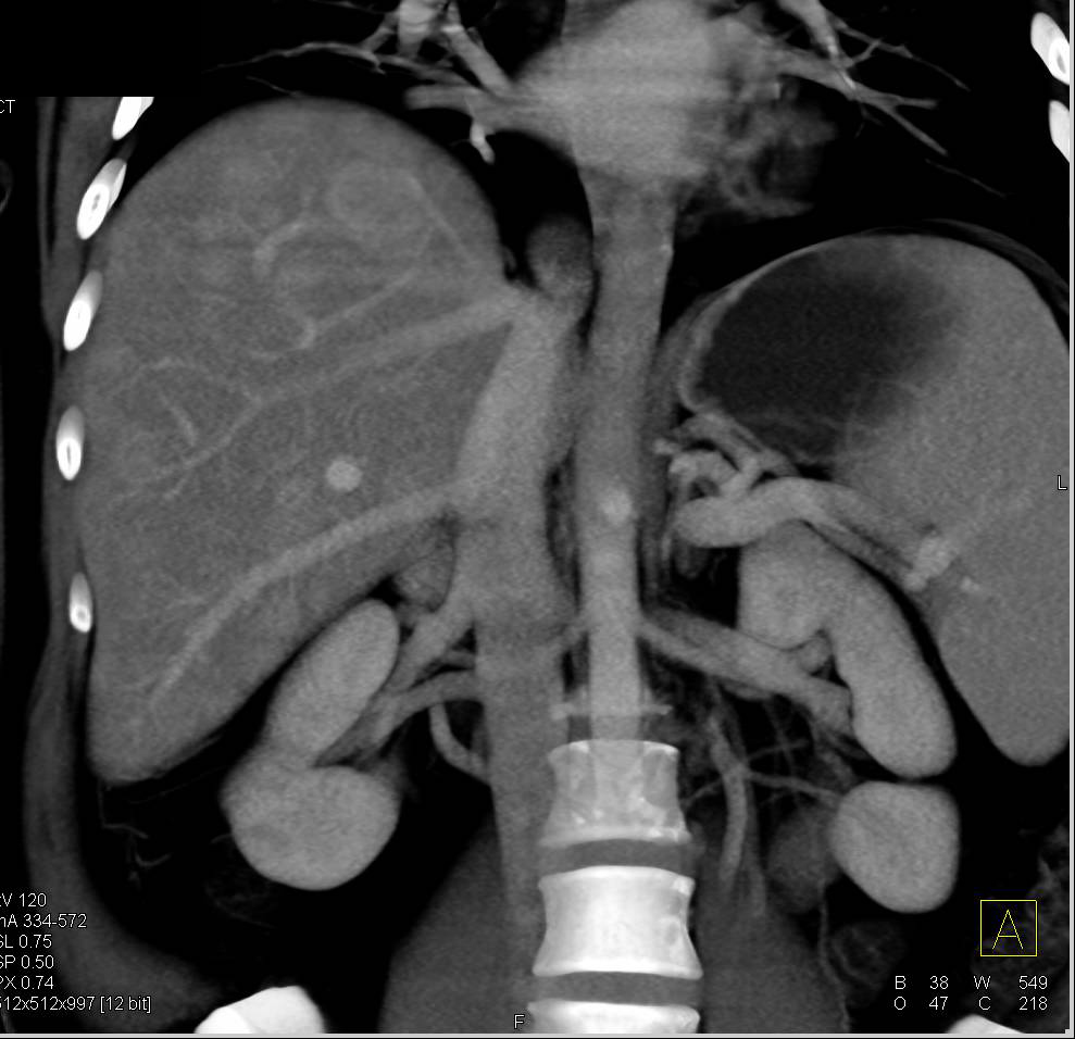 Carcinoid Tumor with Mass in the Mesentery and Liver Metastases - CTisus CT Scan