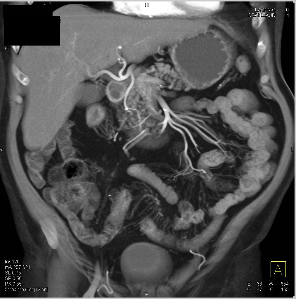 Crohn's with Prominent Vasa Recta - CTisus CT Scan