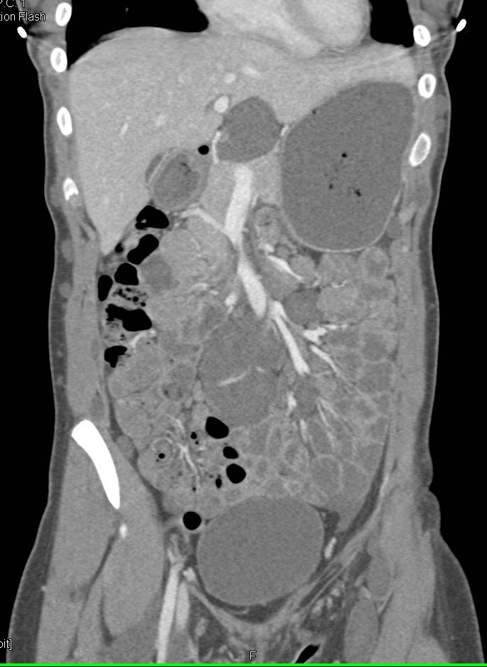 Mesenteric Masses due to Neurofibromatosis. Subcutaneous nodules also seen - CTisus CT Scan