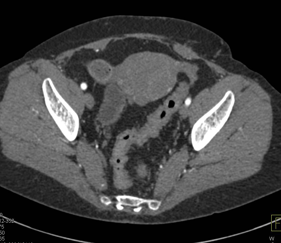 Crohn's Disease Terminal Ileum - CTisus CT Scan