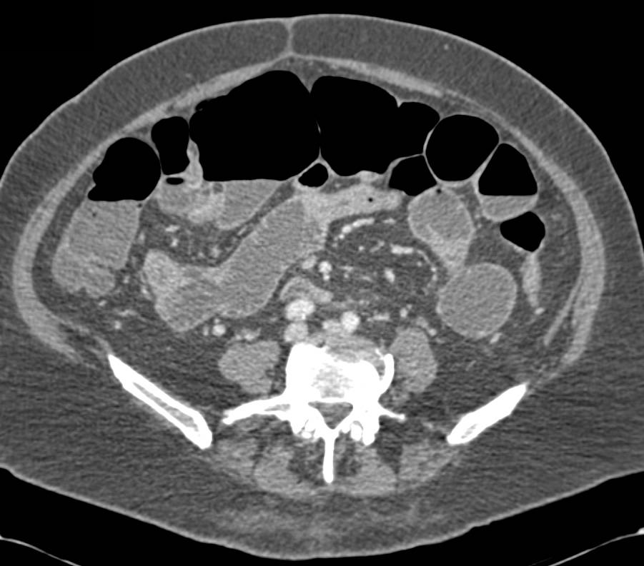 Adenocarcinoma of the Small Bowel in 3D - CTisus CT Scan