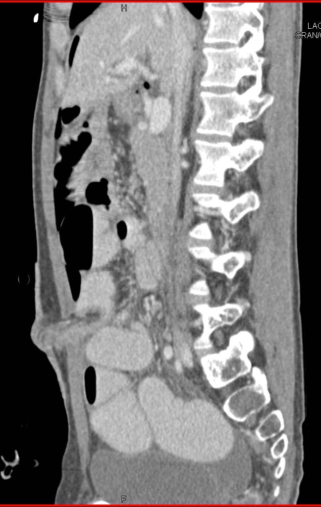 Dilated Small Bowel with Obstruction - CTisus CT Scan