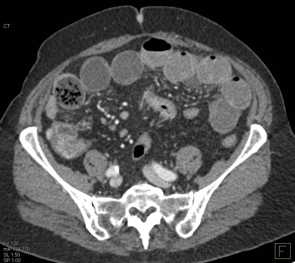 Crohn's Disease Terminal Ileum and Prominent Vasa Recta - CTisus CT Scan