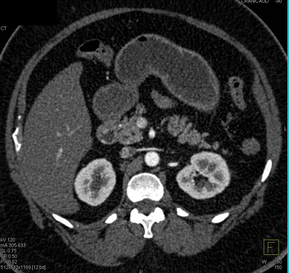 Neuroendocrine Tumor in Duodenum - CTisus CT Scan