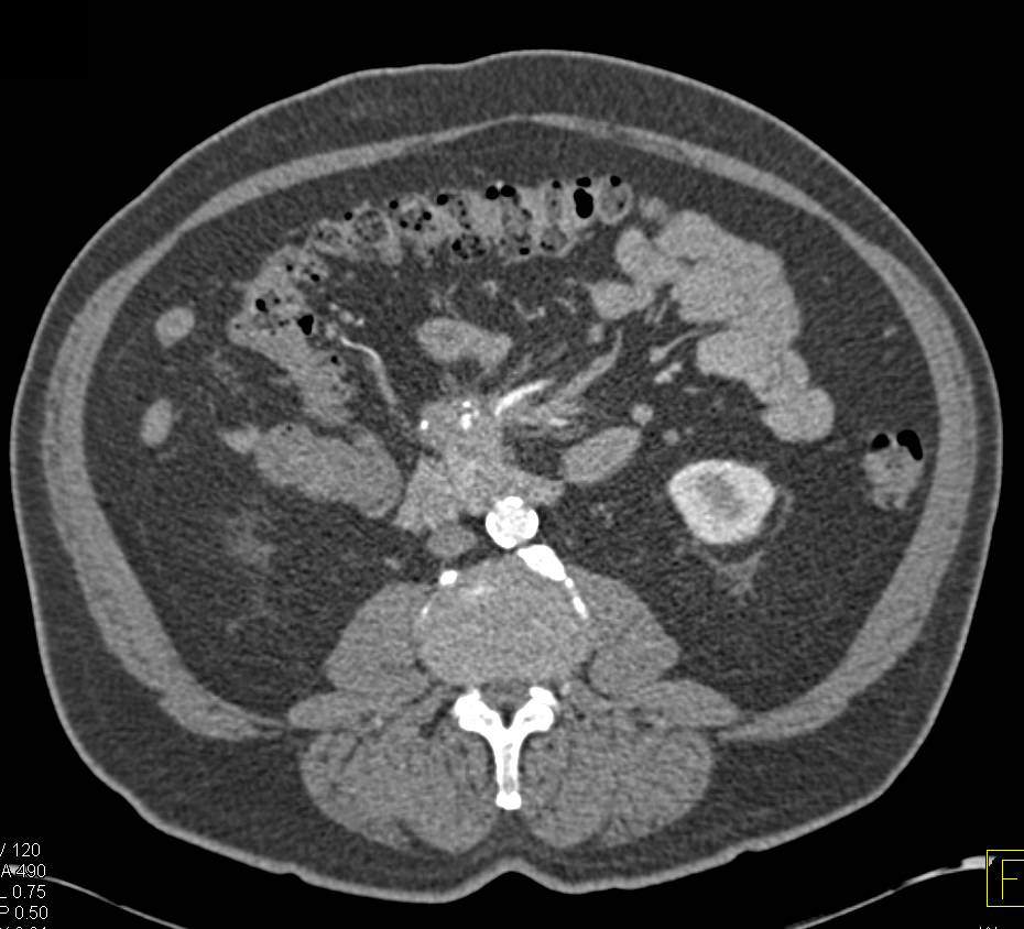 Carcinoid Tumor with encased Superior Mesenteric Artery (SMA)/Superior Mesenteric Vein (SMV) - CTisus CT Scan