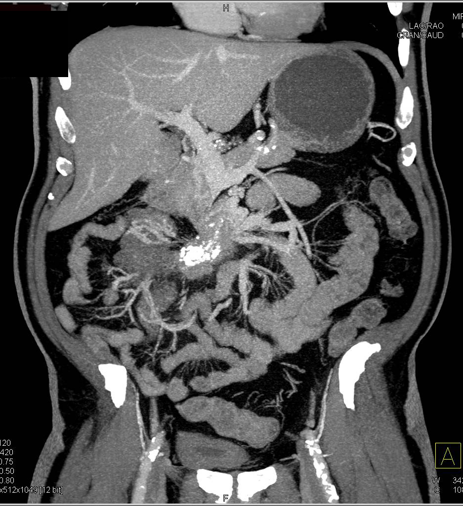 Carcinoid in the Root of the Mesentery - CTisus CT Scan