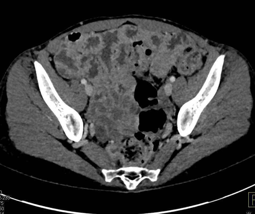Diffuse Thickening of Small Bowel - CTisus CT Scan