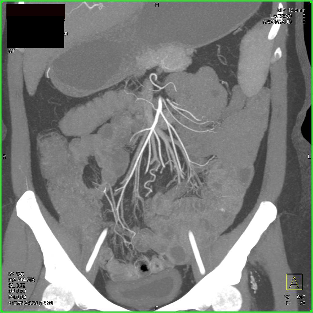 Small Vascular Lesion in Jejunum - CTisus CT Scan