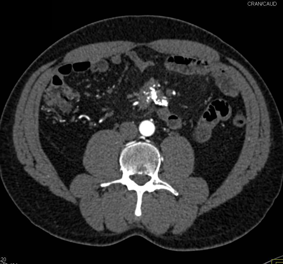 Sclerosing Mesenteritis with Calcified Mesenteric Mass - CTisus CT Scan