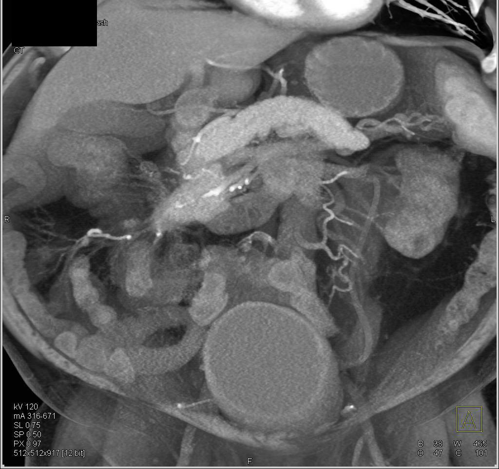 Carcinoid Tumor with Desmoplastic Reaction Simulates a Pancreatic Cancer - CTisus CT Scan