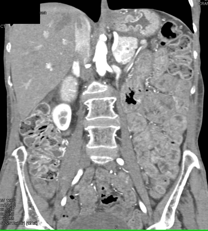 Thickening of Proximal Jejunal Small Bowel Loops - CTisus CT Scan