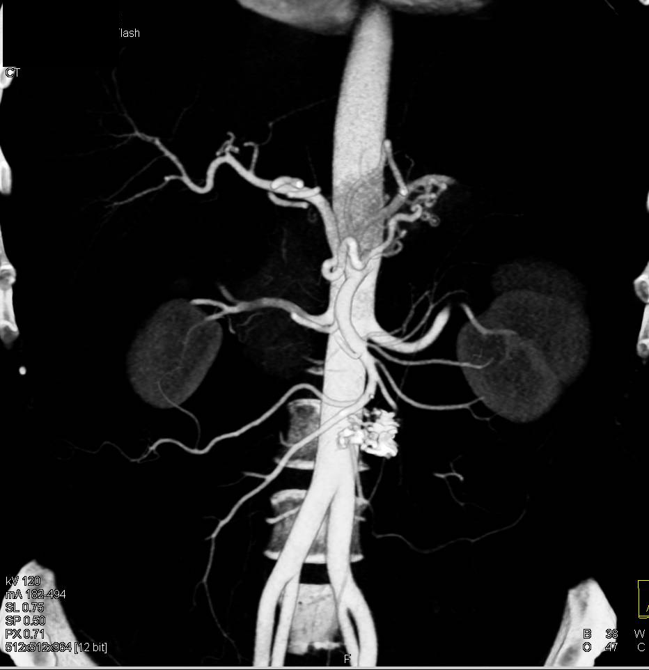 Sclerosing Mesenteritis with Calcified Mesenteric Mass in Root of Mesentery - CTisus CT Scan