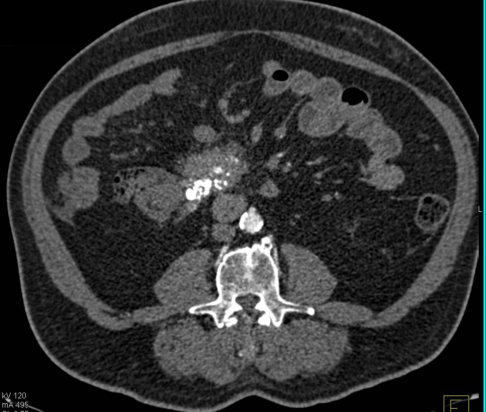 Carcinoid Tumor Near Uncinate Process Simulates a Pancreatic Mass - CTisus CT Scan