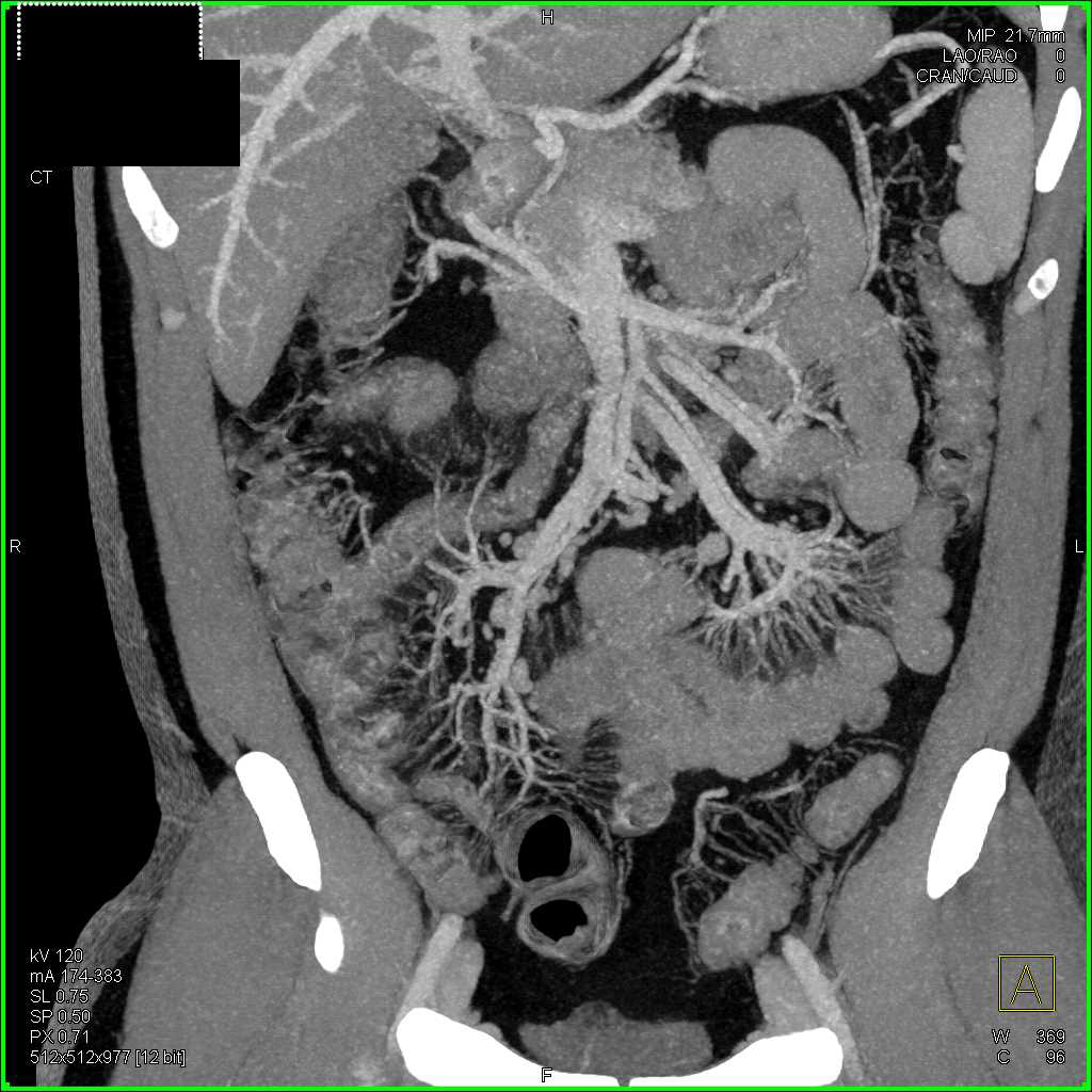 Crohn's Disease with Prominent Vasa Recta and Comb Sign - CTisus CT Scan