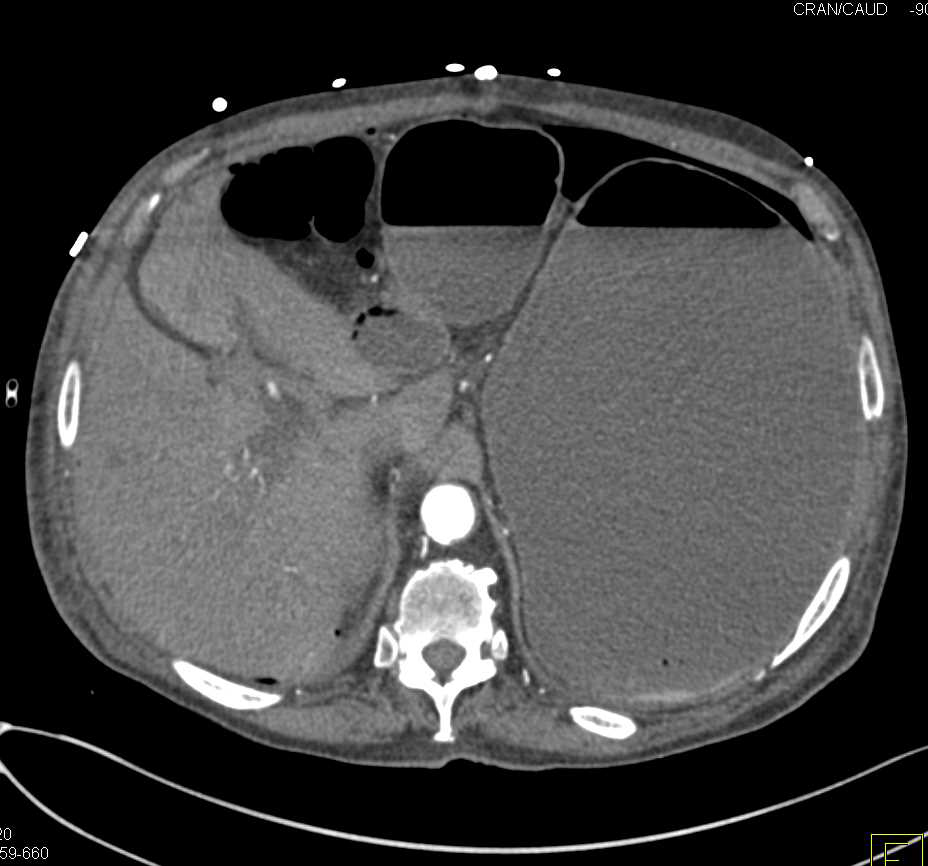 Small Bowel Obstruction due to Adhesions - CTisus CT Scan