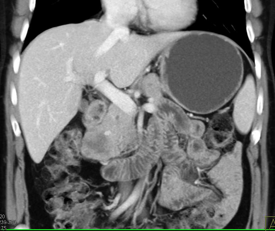 Unusual Appearance of Duodenal Adenocarcinoma - CTisus CT Scan