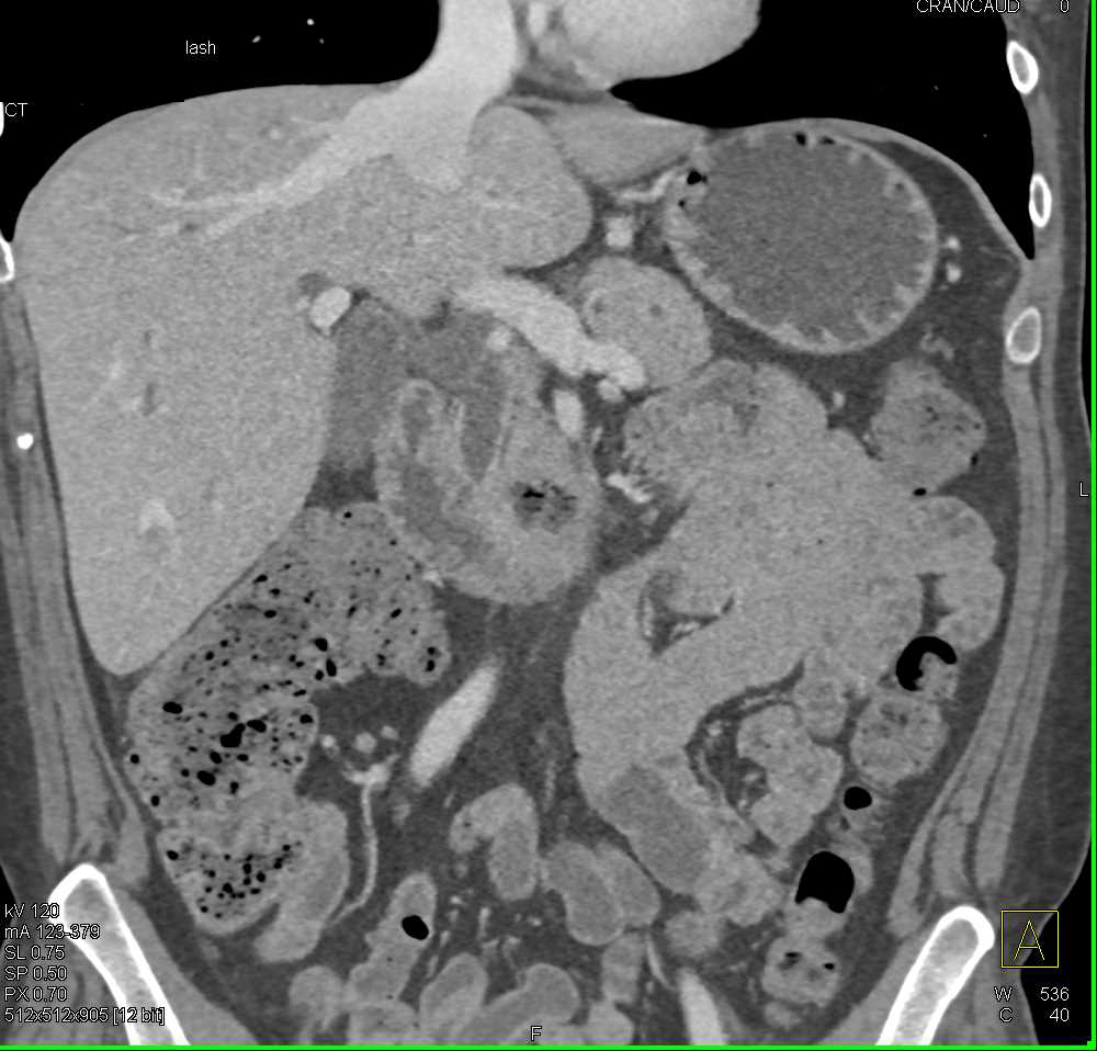 Carcinoma in the 4th Portion of the Duodenum - CTisus CT Scan