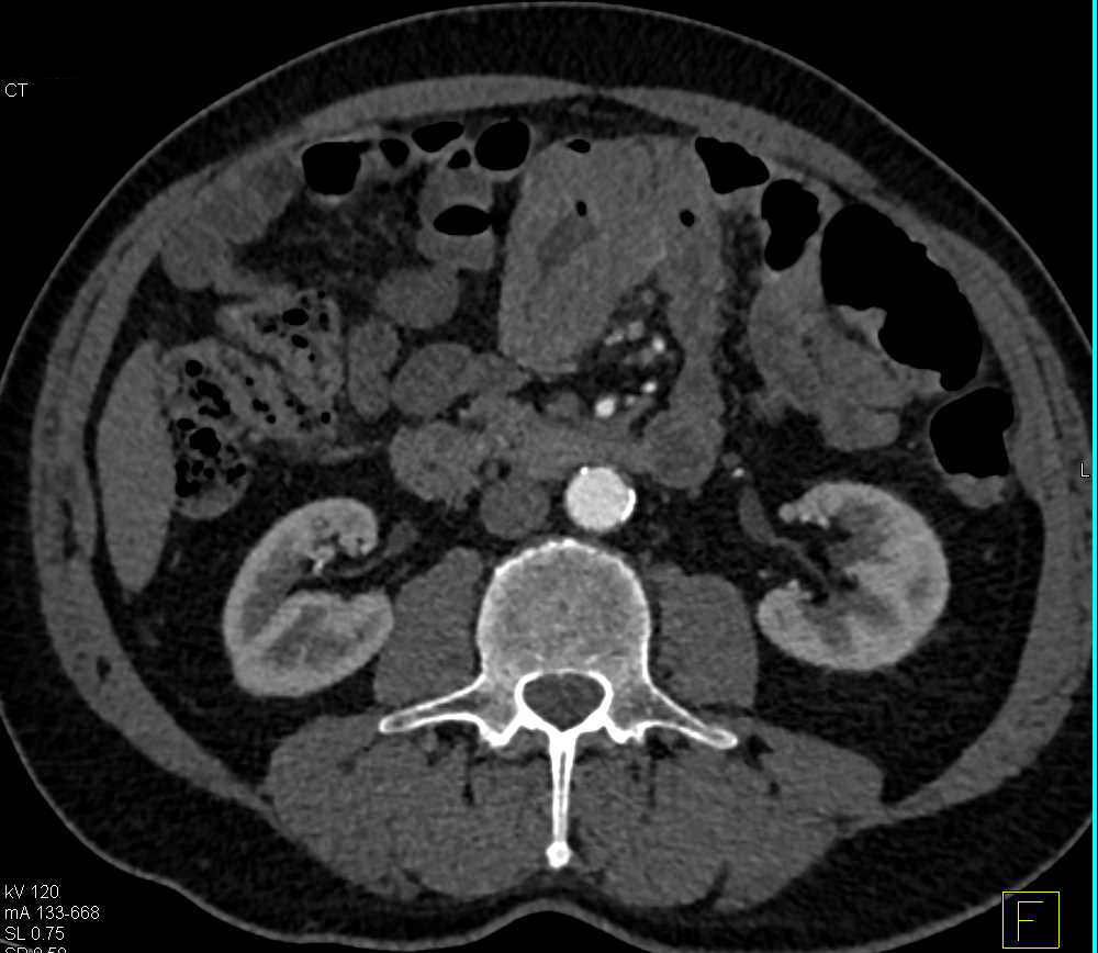 Small Bowel Adenocarcinoma - CTisus CT Scan