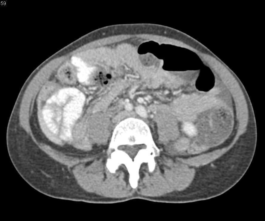 Small Bowel Obstruction with the Feces Sign - CTisus CT Scan