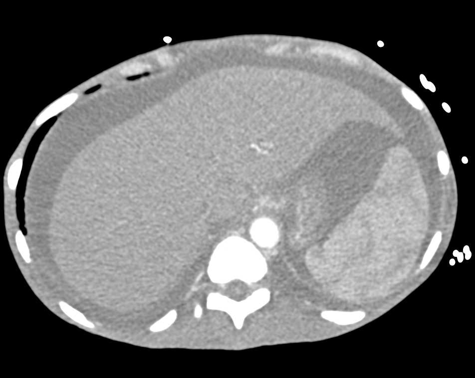 Wet Bowel Pattern due to Chronic Liver Disease - CTisus CT Scan