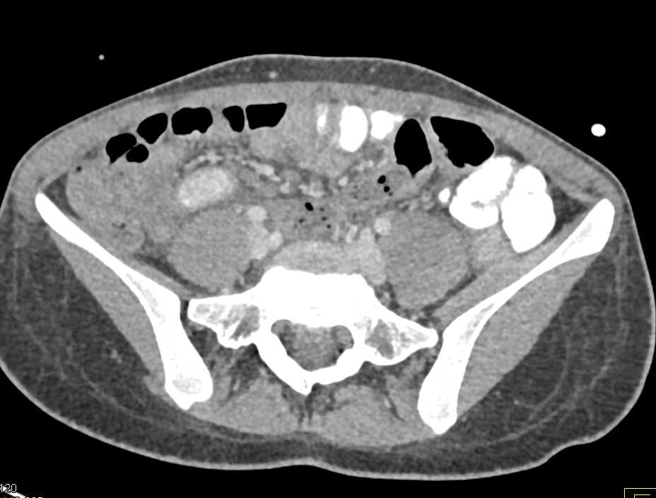 Focal Bowel Perforation - CTisus CT Scan