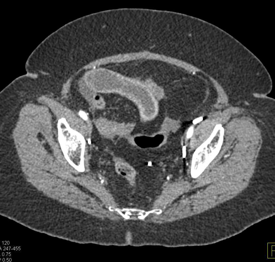 Active Crohn's Disease Ileum with Prominent Vasa Recta with Comb Sign - CTisus CT Scan
