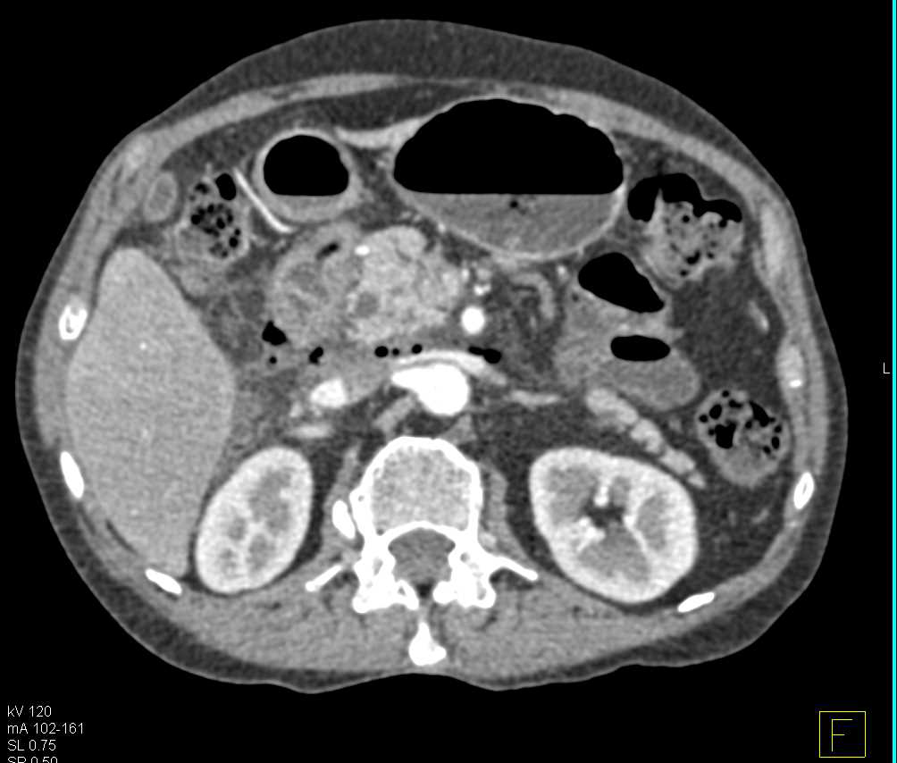 Duodenal Perforation s/p Endoscopic Retrograde Cholangiopancreatography (ERCP) with Secondary Pancreatitis - CTisus CT Scan