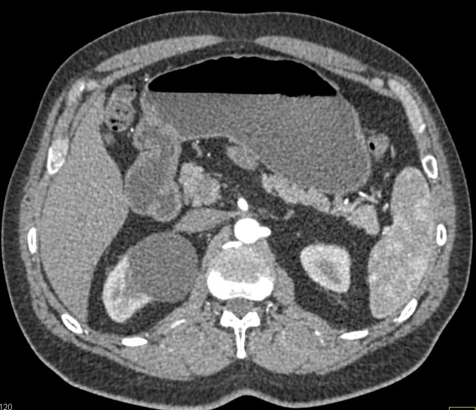 Mass in Mesentery is Sclerosing Mesenteritis with Dense Calcification - CTisus CT Scan