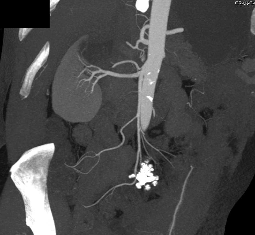 Mass in Mesentery is Sclerosing Mesenteritis with Dense Calcification - CTisus CT Scan