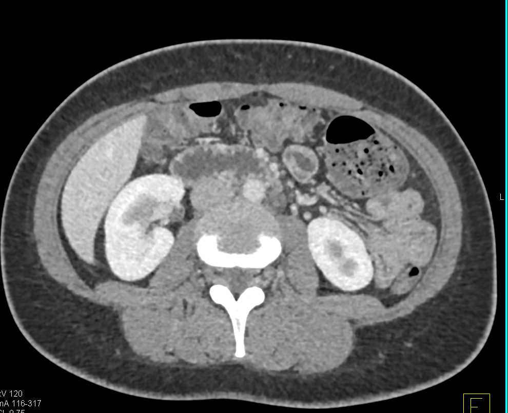 Normal Duodenum - CTisus CT Scan