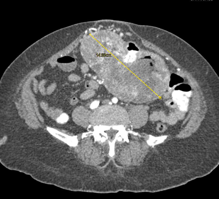 Small Bowel Adenocarcinoma Hard to Differentiate from a GIST Tumor or Lymphoma - CTisus CT Scan