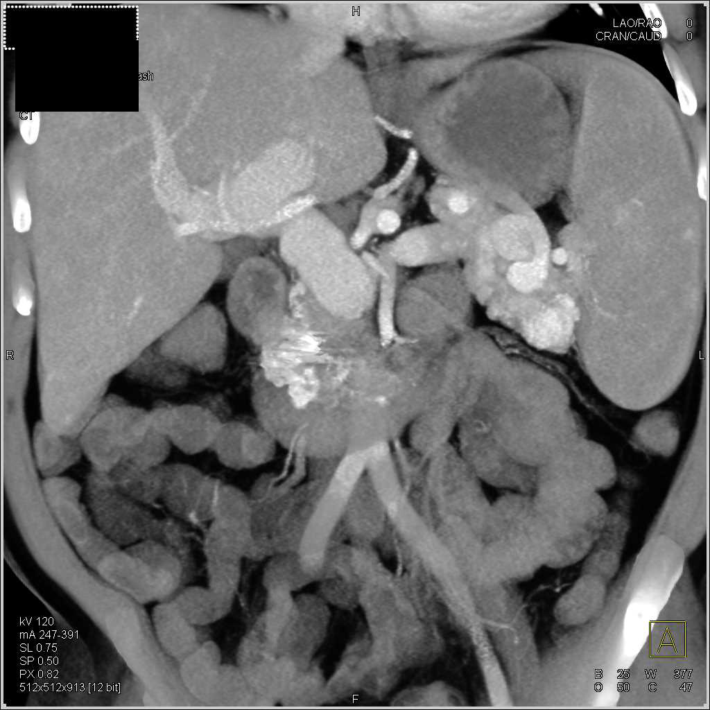 Carcinoid Tumor with Liver Metastases - CTisus CT Scan