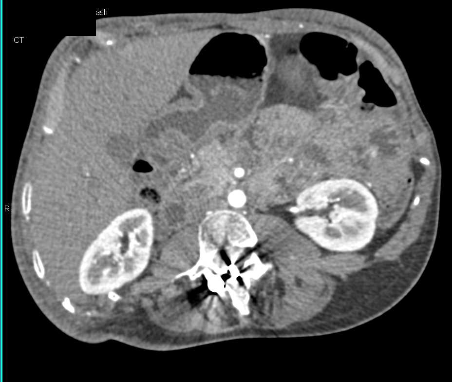 Dilated Small Bowel Without Cause for Obstruction - CTisus CT Scan
