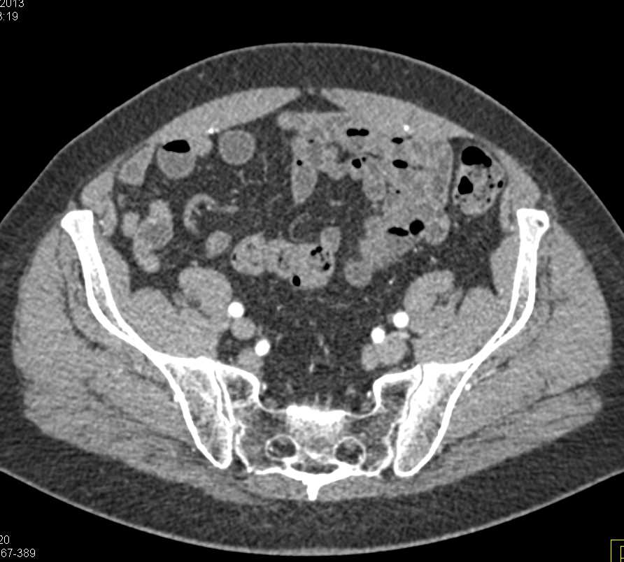 Calcifications in Root of Mesentery - CTisus CT Scan