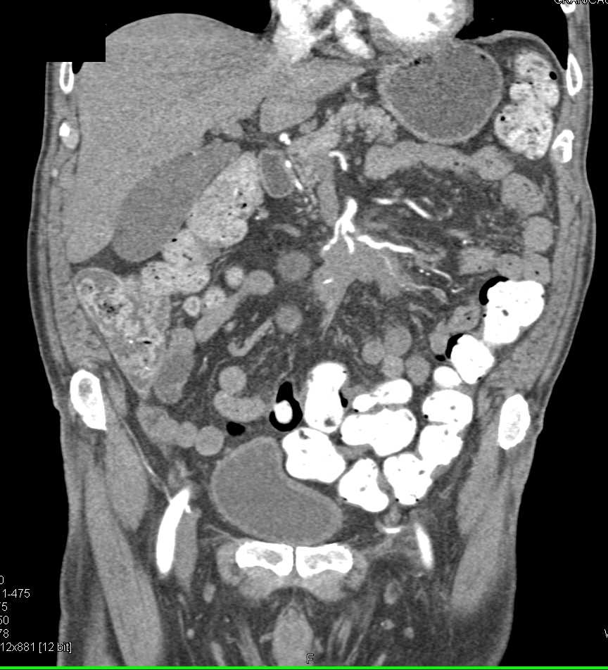 Carcinoid Tumor in Root of Mesentery Encases Superior Mesenteric Artery (SMA) Branches - CTisus CT Scan