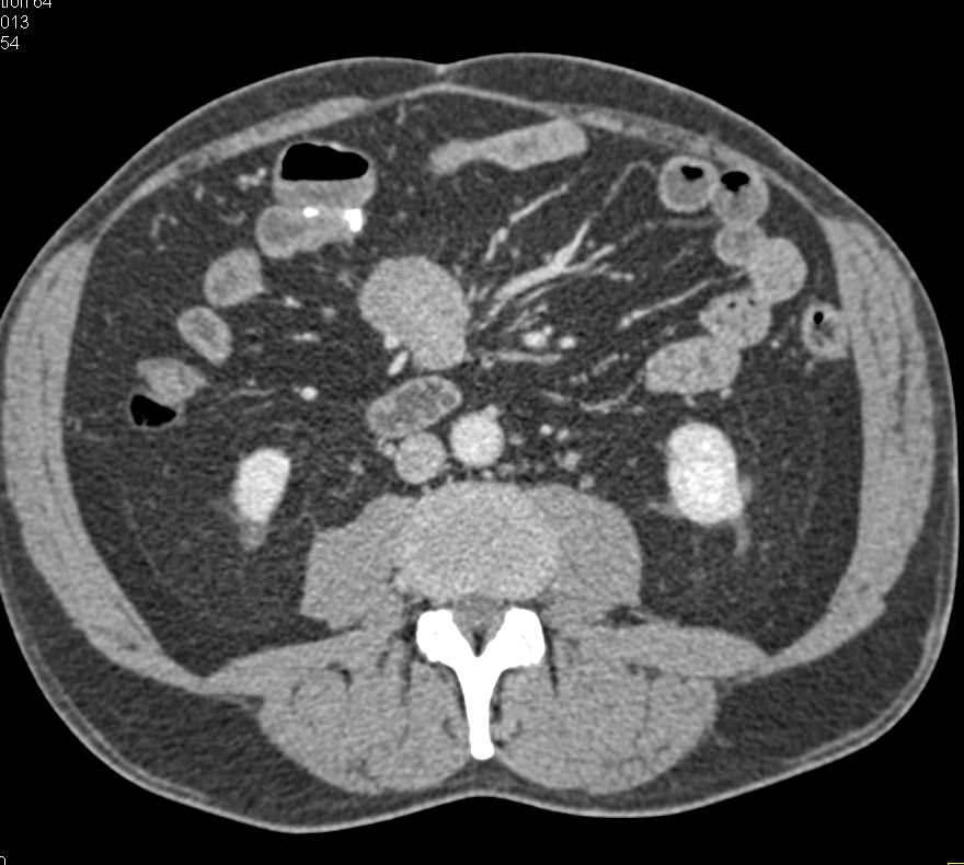 Carcinoid Tumor in Root of Mesentery with Vascular Liver Metastases - CTisus CT Scan