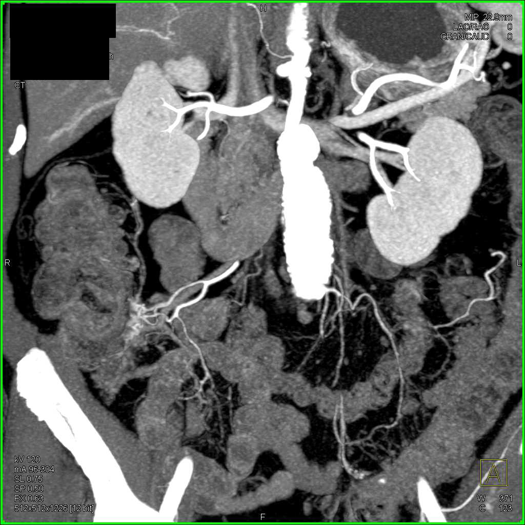 Carcinoid Tumor Near Terminal Ileum - CTisus CT Scan