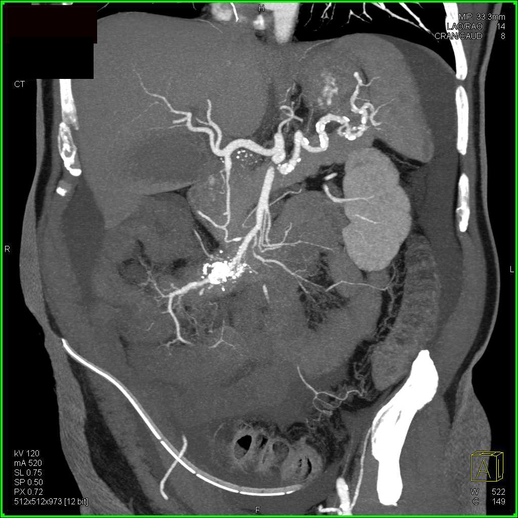 Carcinoid Tumor Near Root of the Mesentery with Desmoplastic Reaction - CTisus CT Scan