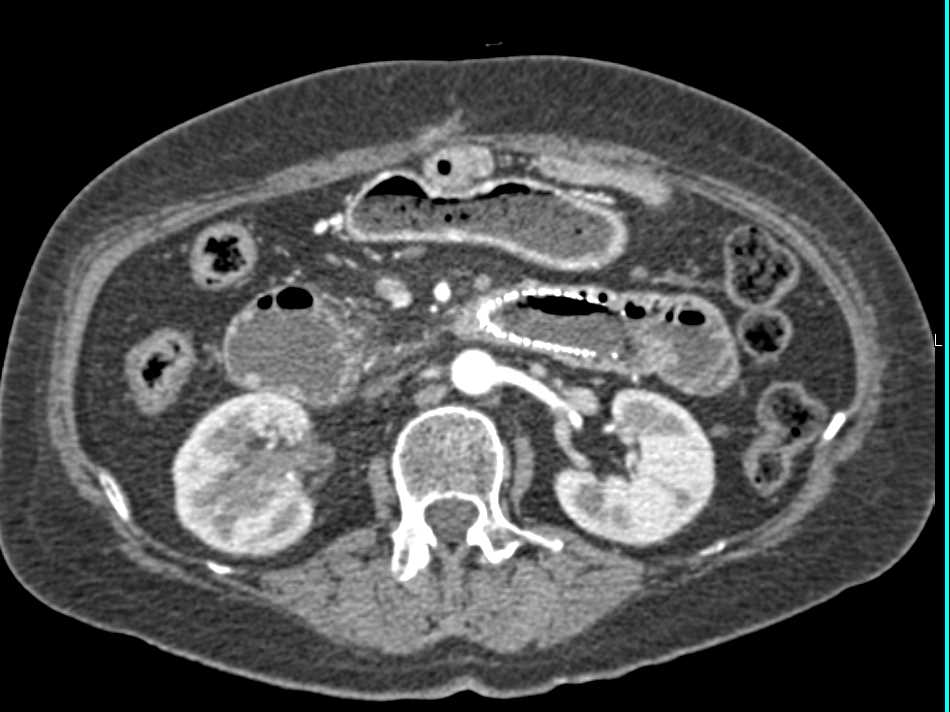 Duodenal Cancer with Stent in Duodenum - CTisus CT Scan