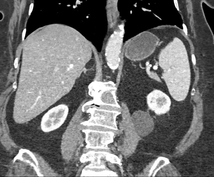 Mesenteric Cyst - CTisus CT Scan