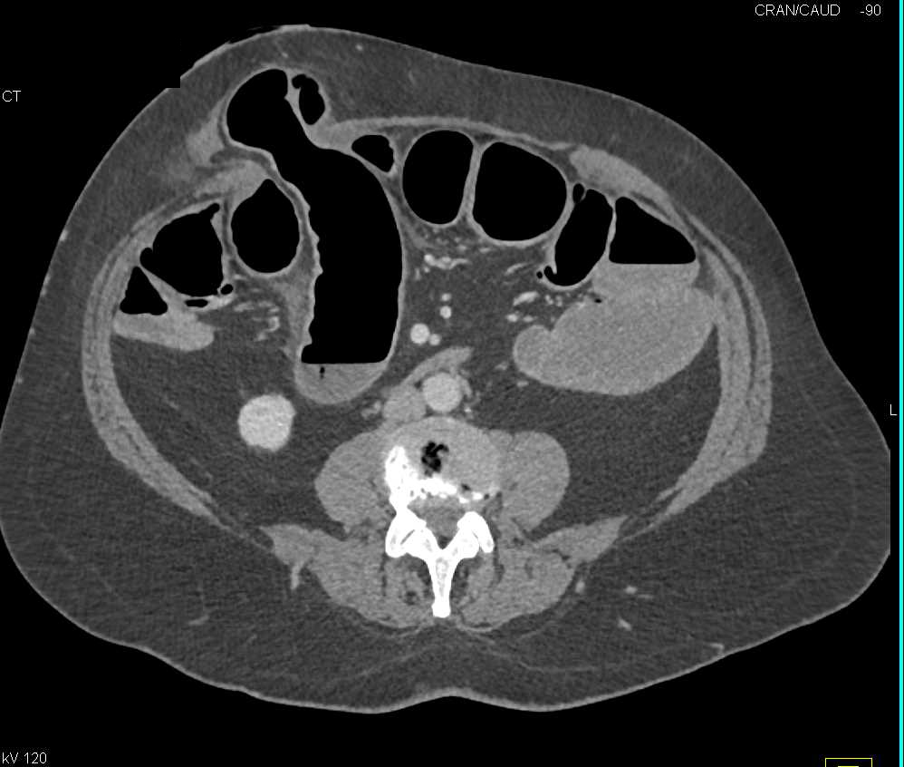 Small Bowel Obstruction (SBO) due to Abdominal Wall Hernia - CTisus CT Scan
