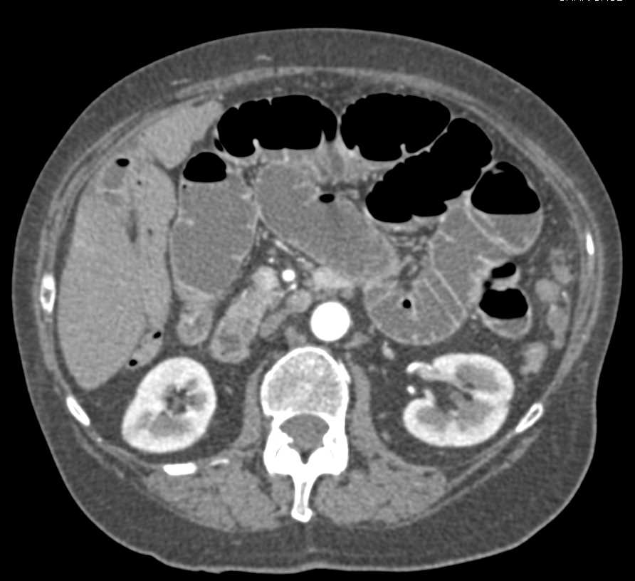 Colon Cancer with Implants in Pelvis Obstructing the Small Bowel - CTisus CT Scan