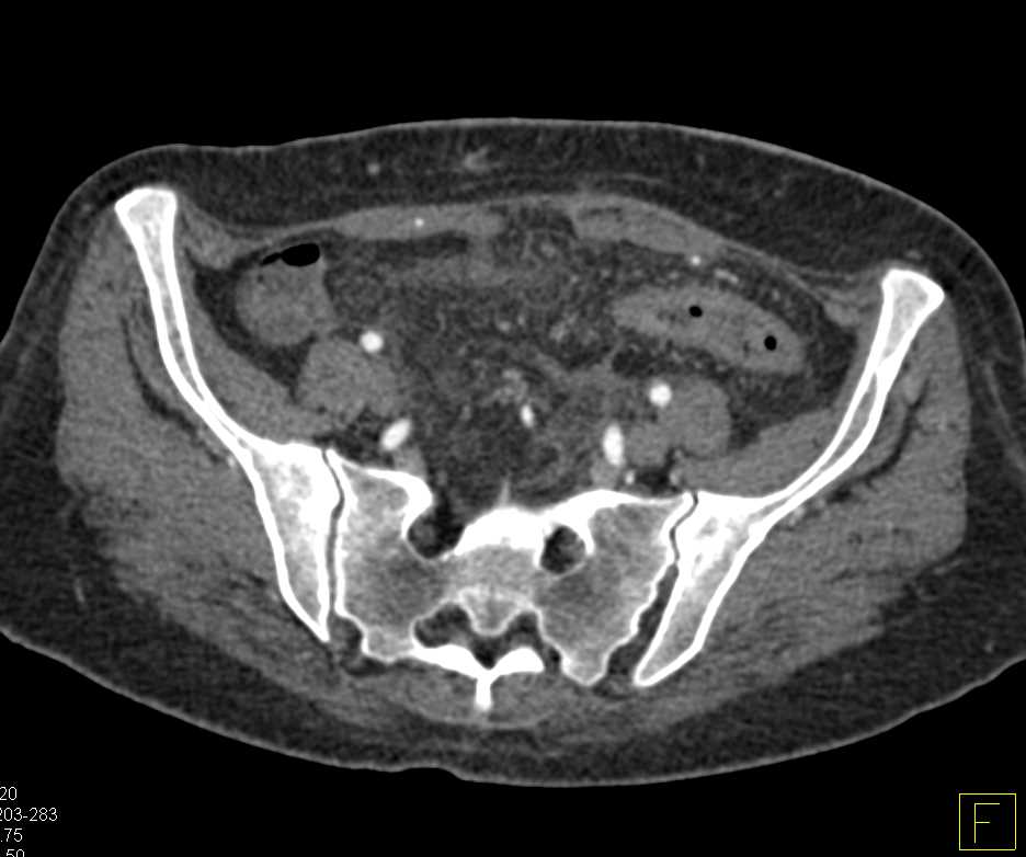 Crohn's Disease with Entero-enteric Fistulae - CTisus CT Scan
