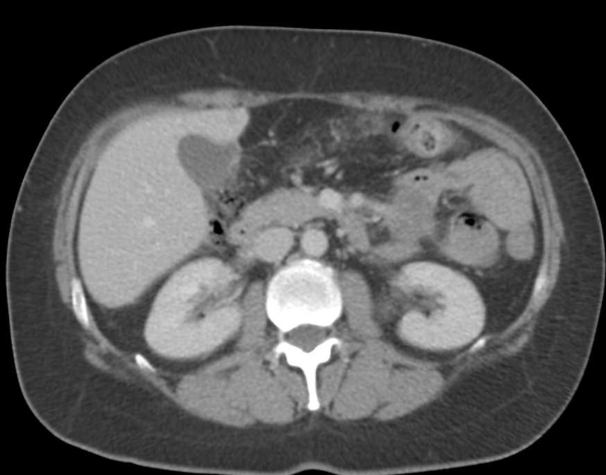 Carcinoid Tumor in the Root of the Mesentery - CTisus CT Scan