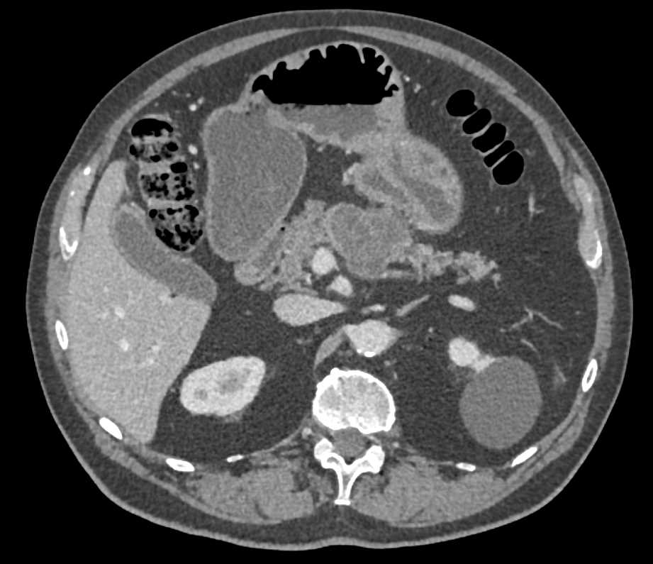 Incidental Small Bowel Lipoma (Jejunum) in Patient with MCN (Mucinous Cystic Neoplasm) Pancreas - CTisus CT Scan