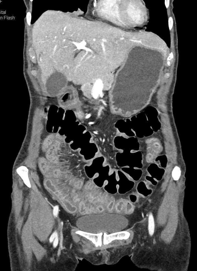Thickened Distal Small Bowel with Graft vs Host Disease post-Bone Marrow Transplant (GVHD) - CTisus CT Scan