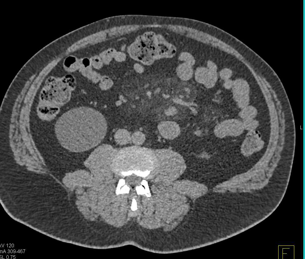 Misty Mesentery due to Sclerosing Mesenteritis - CTisus CT Scan