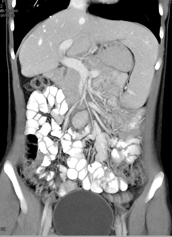 Carcinoid Tumor in the Root of the Mesentery - CTisus CT Scan